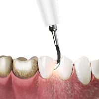 Пародонтологическая чистка